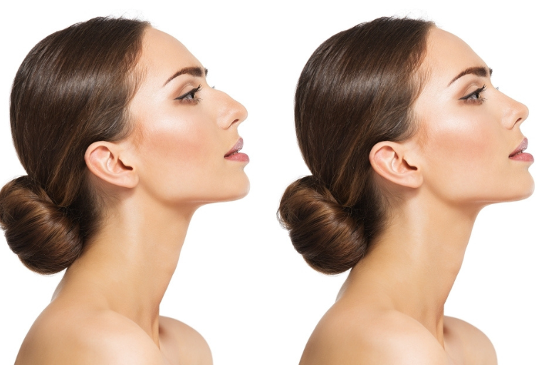 Εξατομικευμένη ρινοπλαστική Γιατί η κάθε μύτη είναι μοναδική